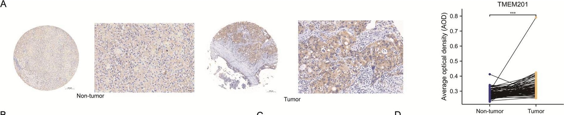 Fig.9.A showing Immunohistochemistry from the publication: Characterization of the Clinical Significance and Immunological Landscapes of a Novel TMEMs Signature in Hepatocellular Carcinoma and the Contribution of TMEM201 to Hepatocarcinogenesis.