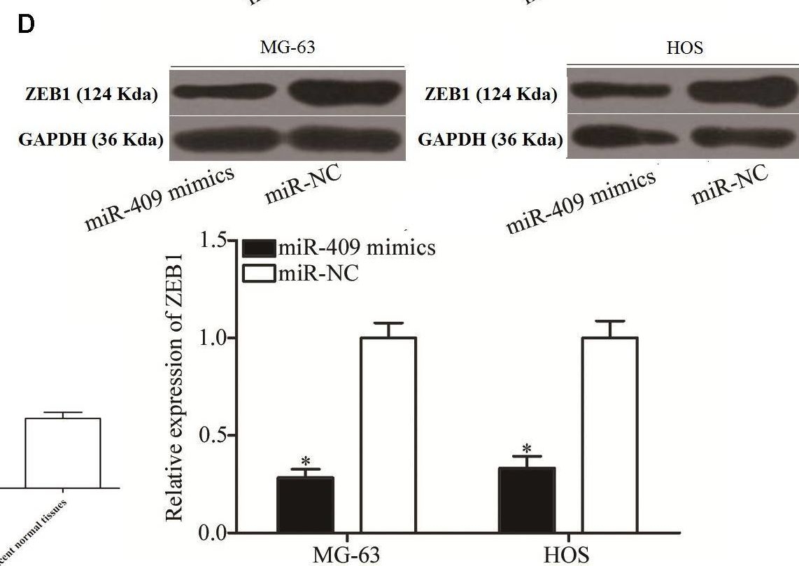 Fig.3.D showing Western Blotting in a Homo sapiens (Human) sample from the publication: MiR-409-3p Inhibits Cell Proliferation and Invasion of Osteosarcoma by Targeting Zinc-Finger E-Box-Binding Homeobox-1.