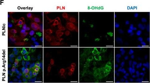 Fig.6.F showing Immunocytochemistry-immunofluorescence in a Homo sapiens (Human) sample from the publication: Impairment of the ER/mitochondria compartment in human cardiomyocytes with PLN p.Arg14del mutation.