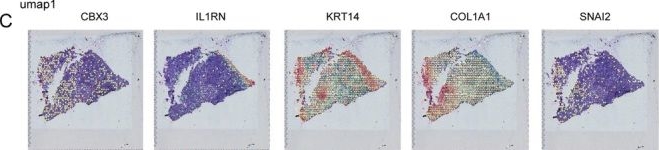 Fig.9.C showing Immunohistochemistry in a Homo sapiens (Human) sample from the publication: CBX3:IL1RN Reflects Distinct Cellular States That Defines the Clinical Outcome of Oral Squamous Cell Carcinoma.