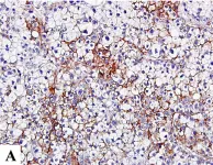 Fig.1.A showing Immunohistochemistry in a Homo sapiens (Human) sample from the publication: Expression of hypoxic marker carbonic anhydrase IX predicts poor prognosis in resectable hepatocellular carcinoma.