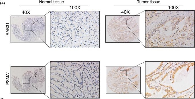 Fig.6.A showing Immunohistochemistry from the publication: Overexpression of RAB31 in gastric cancer is associated with released exosomes and increased tumor cell invasion and metastasis.