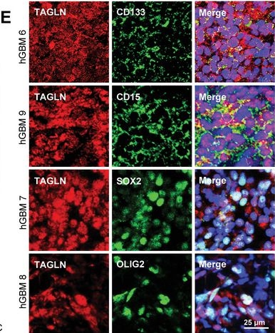 Fig.2.E showing Immunohistochemistry-immunofluorescence from the publication: Transgelin Promotes Glioblastoma Stem Cell Hypoxic Responses and Maintenance Through p53 Acetylation.