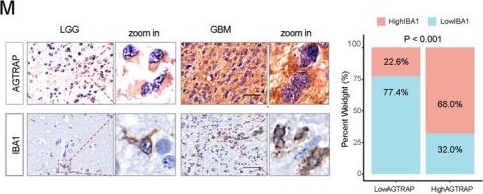 Fig.1.M showing Immunohistochemistry from the publication: Angiotensin II Receptor-Associated Protein (AGTRAP) Enhances Glioma Cell Survival Through the IL-6/JAK2/STAT3 Pathway and Correlates With an Immunosuppressive Microenvironment.