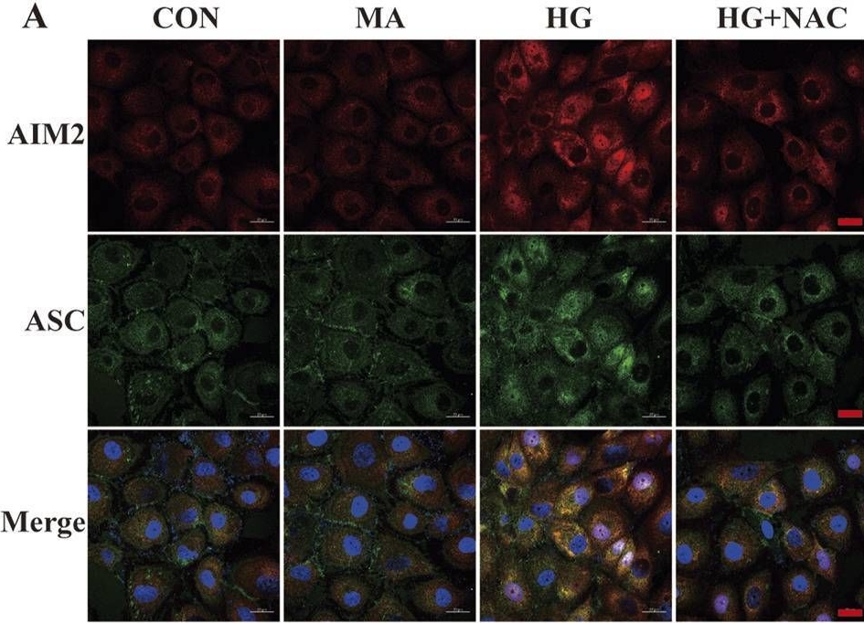 Fig.6.A showing Immunocytochemistry-immunofluorescence in a Homo sapiens (Human) sample from the publication: DNA damage-induced AIM2 pyroptosis in high glucose-induced proximal tubular epithelial cell.