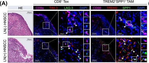 Fig.7.A showing Immunohistochemistry-immunofluorescence in a Homo sapiens (Human) sample from the publication: Comprehensive tumour-immune profiling reveals TREM2+ tumour-associated macrophages facilitating lymph node metastasis in head and neck squamous cell carcinoma.