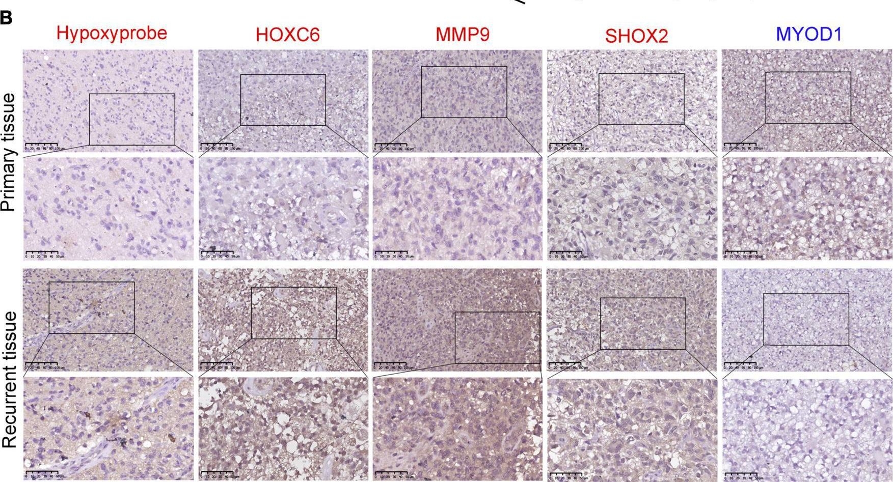 Fig.6.B showing Immunohistochemistry in a Homo sapiens (Human) sample from the publication: A novel hypoxia-driven gene signature that can predict the prognosis and drug resistance of gliomas.