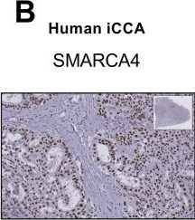 Fig.8.B showing Immunohistochemistry from the publication: Transcriptomic profiling of epigenetic regulators and metabolic reprogramming in human cholangiocarcinoma.