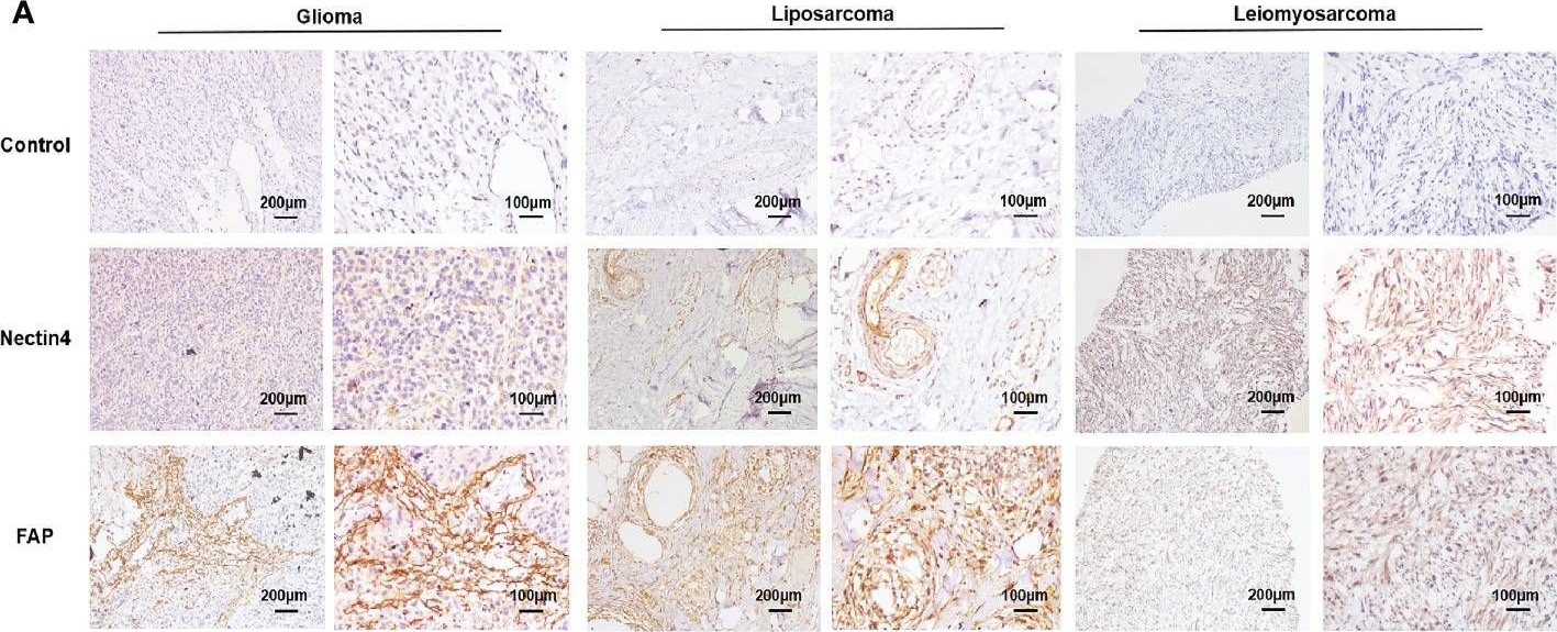 Fig.1.A showing Immunohistochemistry from the publication: Development of Nectin4/FAP-targeted CAR-T cells secreting IL-7, CCL19, and IL-12 for malignant solid tumors.