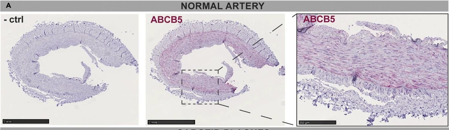 Fig.5.A showing Immunohistochemistry from the publication: Clinical risk scores for stroke correlate with molecular signatures of vulnerability in symptomatic carotid patients.