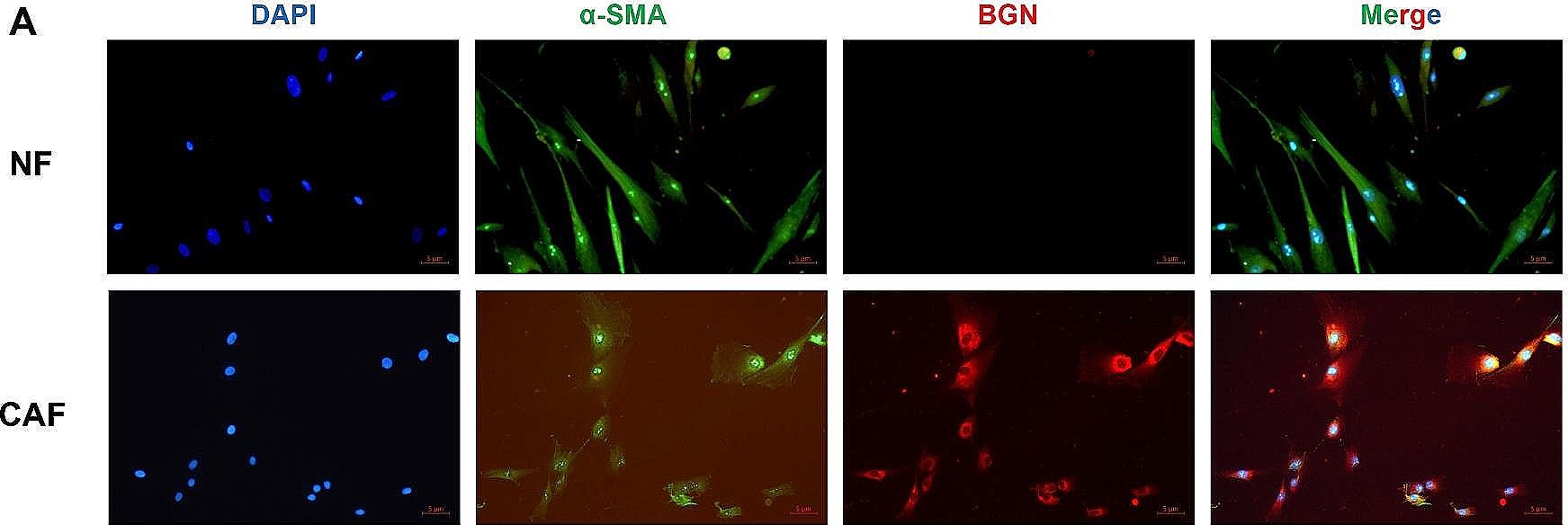 Fig.3.A showing Immunocytochemistry-immunofluorescence in a Homo sapiens (Human) sample from the publication: Identification of BGN positive fibroblasts as a driving factor for colorectal cancer and development of its related prognostic model combined with machine learning.