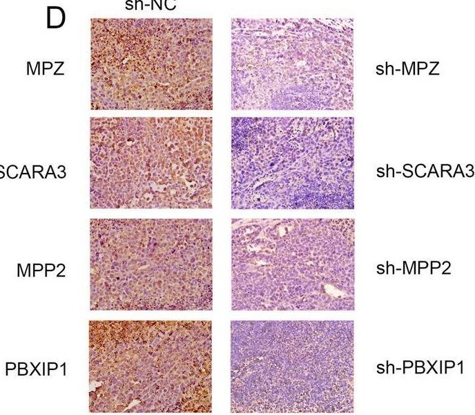 Fig.10.D showing Immunohistochemistry in a Homo sapiens (Human) sample from the publication: Single-cell and WGCNA uncover a prognostic model and potential oncogenes in colorectal cancer.