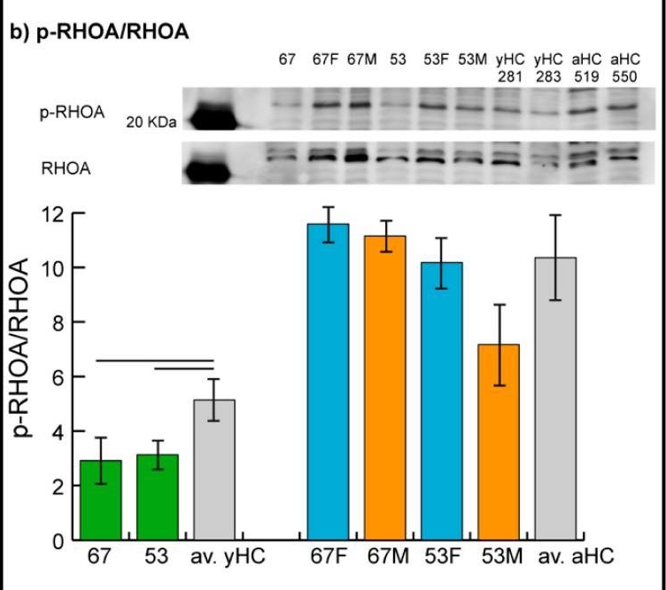 Fig.3.B showing Western Blotting in a Homo sapiens (Human) sample from the publication: Changes of RAS Pathway Phosphorylation in Lymphoblastoid Cell Lines from Noonan Syndrome Patients Carrying Hypomorphic Variants in Two NS Genes.