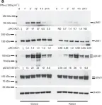 Fig.5.A showing Western Blotting from the publication: Biallelic JAK1 mutations in immunodeficient patient with mycobacterial infection.
