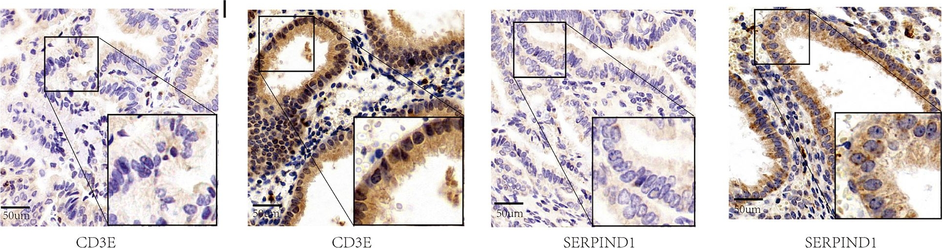 Fig.7.S showing Immunohistochemistry in a Homo sapiens (Human) sample from the publication: A novel immune-related gene signature for diagnosis and potential immunotherapy of microsatellite stable endometrial carcinoma.