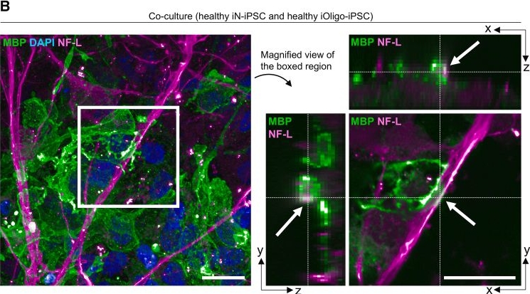 Fig.2.B showing Immunohistochemistry-immunofluorescence from the publication: Nanofiber-based platform for quantitative analysis of human oligodendrocyte ensheathment with pharmacological perturbations.