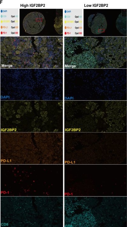 Fig.4.F showing Immunohistochemistry-immunofluorescence in a Homo sapiens (Human) sample from the publication: IGF2BP2 Overexpression Predicts Poor Prognosis and Correlates with PD-L1 Expression in Intrahepatic Cholangiocarcinoma.