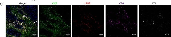 Fig.7.C showing Immunohistochemistry-immunofluorescence from the publication: Plac1+ Tumor Cell-Treg Interplay Supports Tumorigenesis and Progression of Head and Neck Cancer.