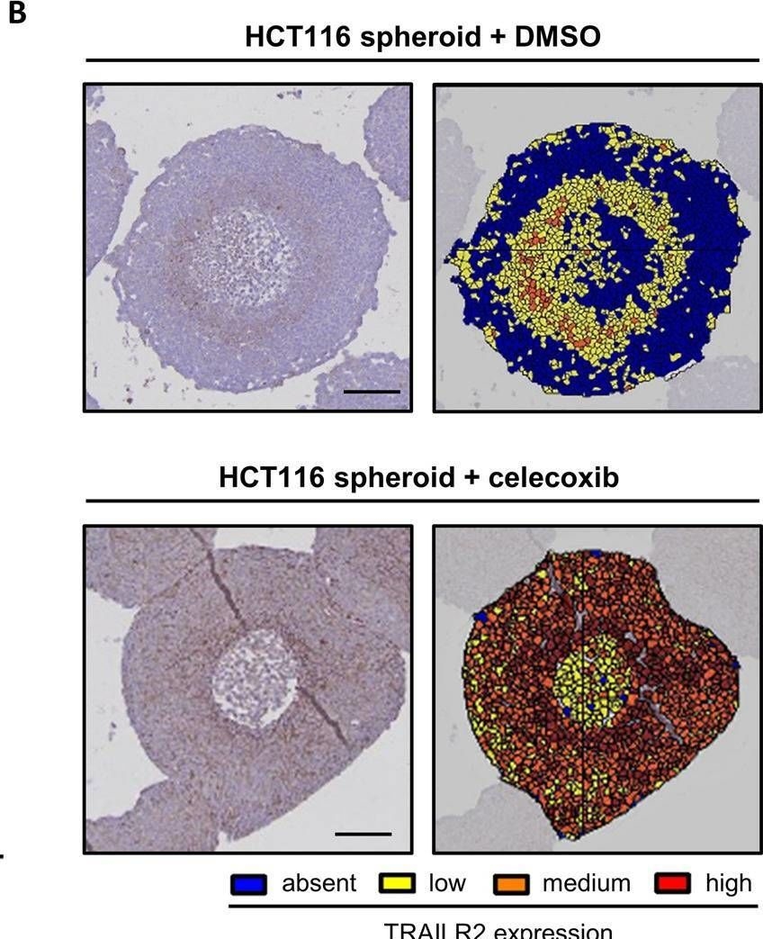 Fig.5.B showing Immunohistochemistry in a Homo sapiens (Human) sample from the publication: Stress-induced TRAILR2 expression overcomes TRAIL resistance in cancer cell spheroids.