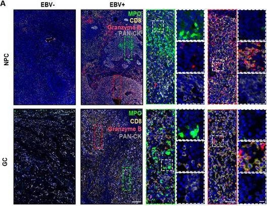 Fig.2.A showing Immunohistochemistry-immunofluorescence in a Homo sapiens (Human) sample from the publication: The CXCL10-CXCR3 Axis Induces Tumor-Associated Neutrophils to Interfere with CTLs-Mediated Antitumor Activity in EBV-Associated Epithelial Cancers.