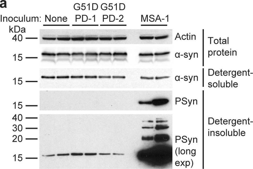 Fig.2.A showing Western Blotting from the publication: The G51D SNCA mutation generates a slowly progressive α-synuclein strain in early-onset Parkinson's disease.