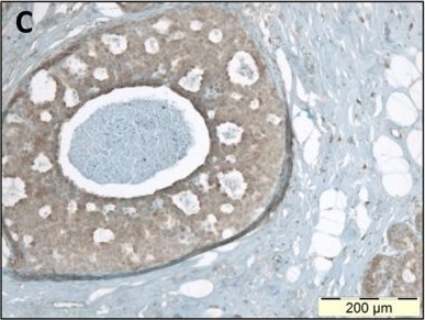 Fig.4.C showing Immunohistochemistry in a Homo sapiens (Human) sample from the publication: Differential regulation of extracellular matrix protein expression in carcinoma-associated fibroblasts by TGF-β1 regulates cancer cell spreading but not adhesion.