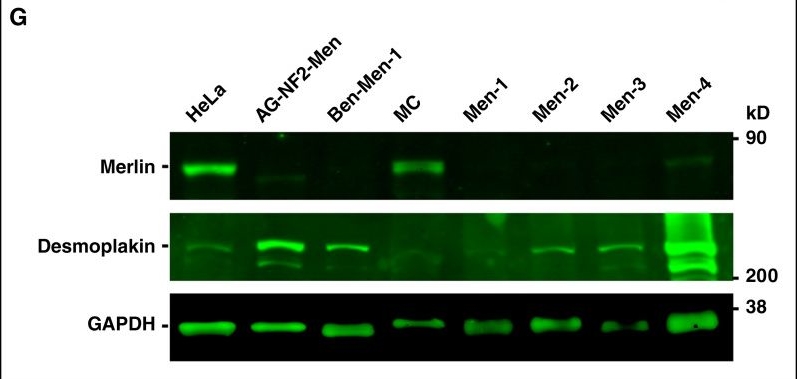 Fig.1.G showing Western Blotting from the publication: Combining Brigatinib with mTOR Inhibition to Effectively Treat NF2-SWN-Associated and Sporadic NF2-Deficient Meningiomas.
