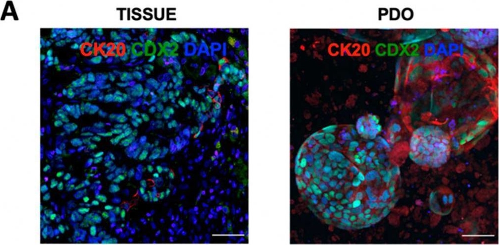 Fig.2.A showing Immunohistochemistry-immunofluorescence in a Homo sapiens (Human) sample from the publication: Renin-Angiotensin Inhibitor, Captopril, Attenuates Growth of Patient-Derived Colorectal Liver Metastasis Organoids.