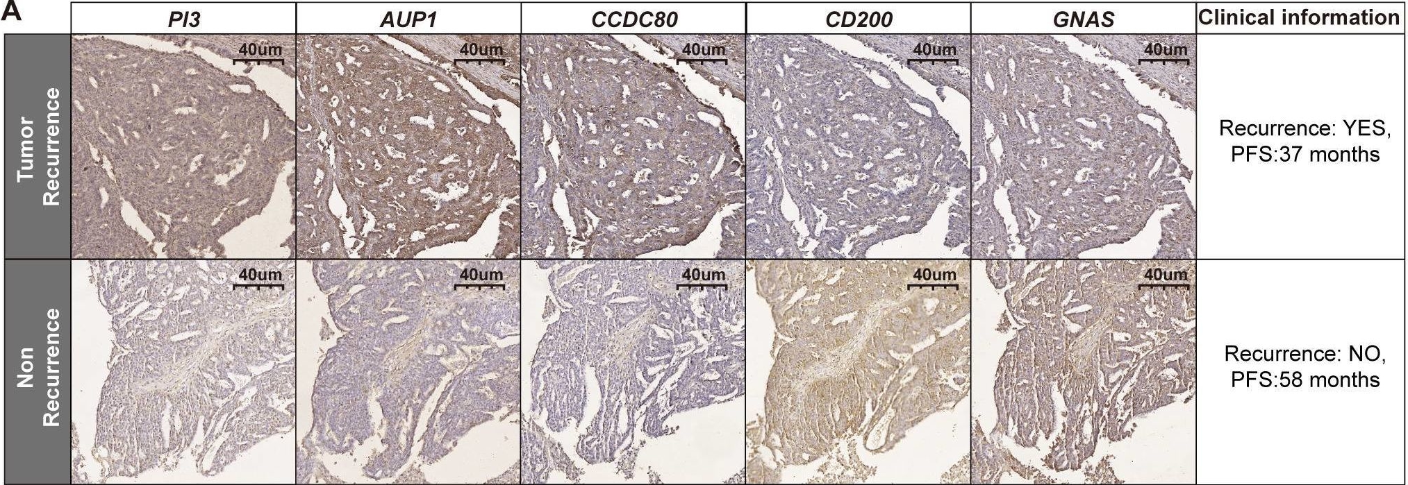 Fig.6.A showing Immunohistochemistry in a Homo sapiens (Human) sample from the publication: Integrated machine learning and single-cell analysis reveal the prognostic and therapeutic potential of SUMOylation-related genes in ovarian cancer.