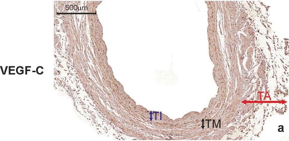 Fig.8.A showing Immunohistochemistry in a Homo sapiens (Human) sample from the publication: Vascular restenosis in coronary artery bypass grafting might be associated with VEGF-C/VEGFR-3 signaling pathway.