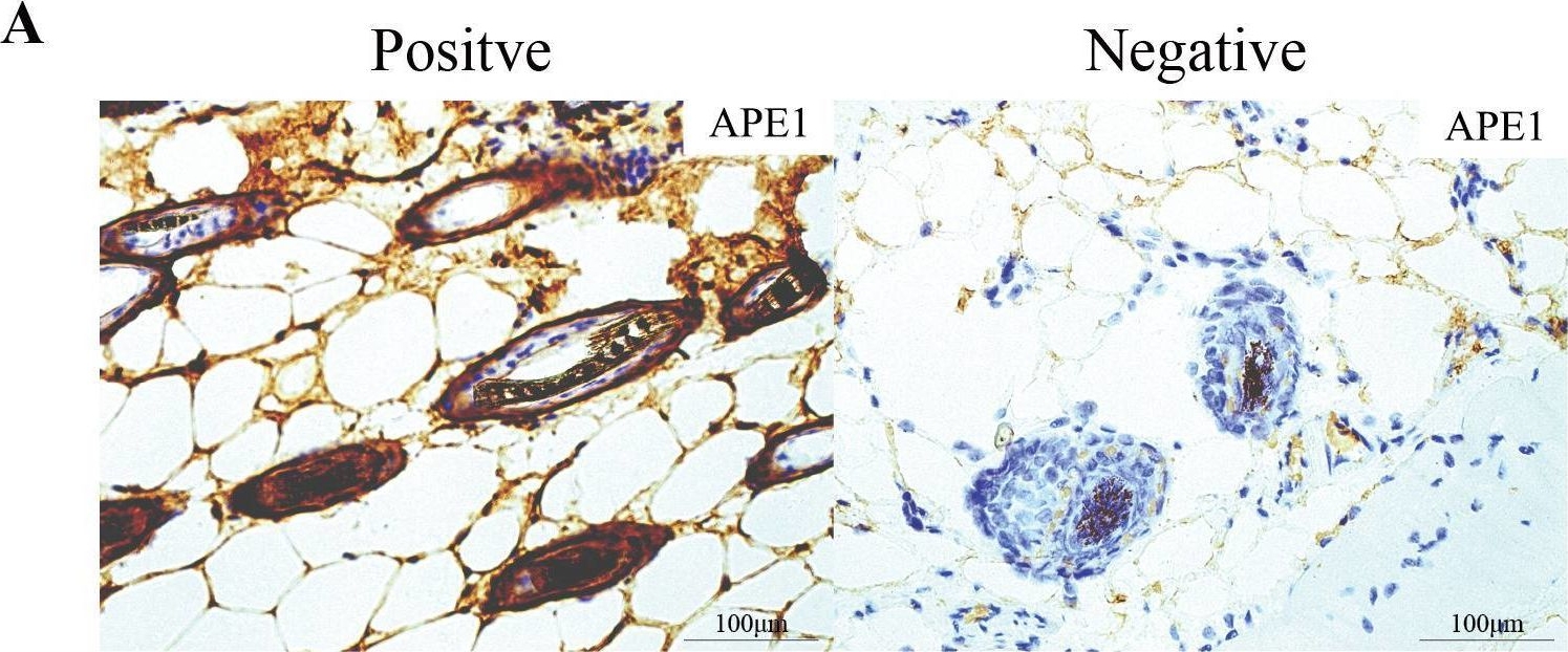 Fig.2.A showing Immunohistochemistry from the publication: APE1 mediates chemoresistance in esophageal squamous cell carcinoma by remodeling the immunosuppressive microenvironment.