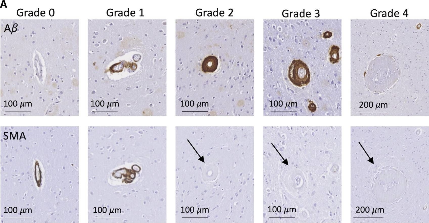 Fig.6.A showing Immunohistochemistry from the publication: Blood-brain barrier leakage and perivascular inflammation in cerebral amyloid angiopathy.