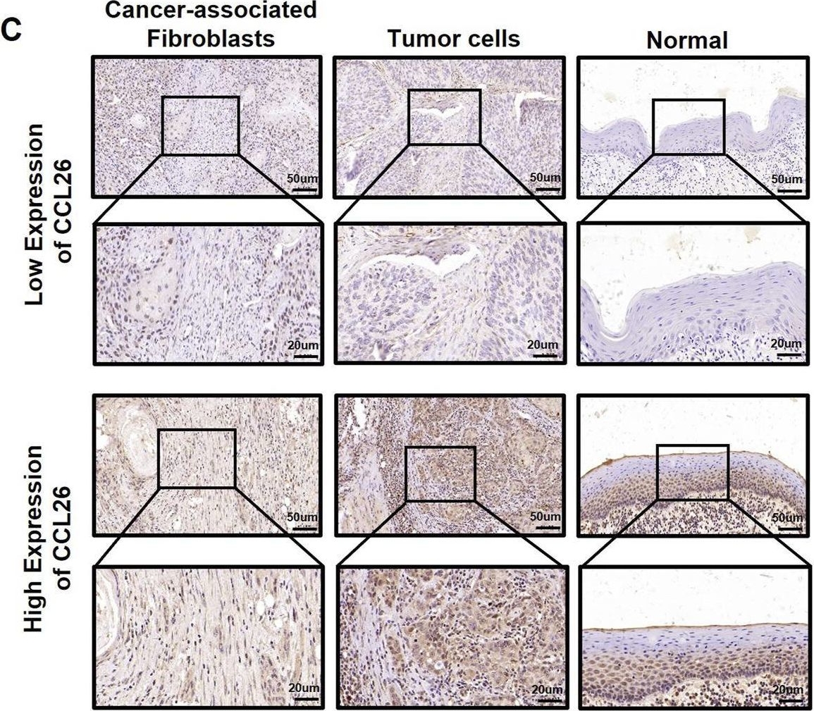 Fig.2.C showing Immunohistochemistry in a Homo sapiens (Human) sample from the publication: The immunological landscape of CCL26High invasive oral squamous cell carcinoma.