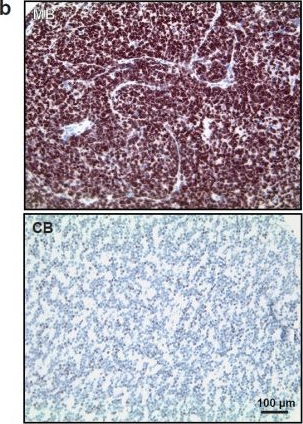 Fig.1.B showing Immunohistochemistry in a Homo sapiens (Human) sample from the publication: The KDM1A histone demethylase is a promising new target for the epigenetic therapy of medulloblastoma.