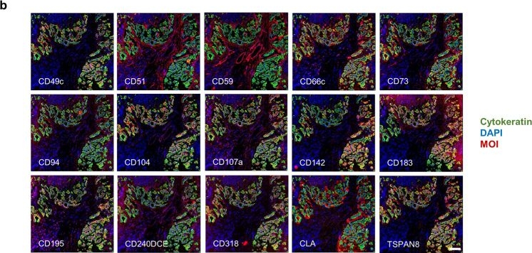 Fig.1.B showing Immunohistochemistry-immunofluorescence in a Homo sapiens (Human) sample from the publication: Identification of CD318, TSPAN8 and CD66c as target candidates for CAR T cell based immunotherapy of pancreatic adenocarcinoma.