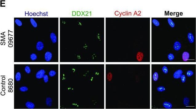 Fig.8.E showing Immunocytochemistry-immunofluorescence in a Homo sapiens (Human) sample from the publication: SMN-deficient cells exhibit increased ribosomal DNA damage.