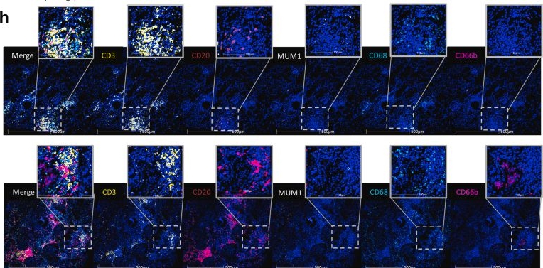 Fig.1.H showing Immunohistochemistry-immunofluorescence in a Homo sapiens (Human) sample from the publication: Immune Profiling Identifies High-Risk Neutrophil-Rich Subtype in Checkpoint Inhibitor Nephritis.