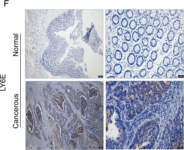 Fig.5.F showing Immunohistochemistry from the publication: A multi-dimensional approach to unravel the intricacies of lactylation related signature for prognostic and therapeutic insight in colorectal cancer.