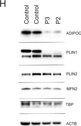 Human biallelic MFN2 mutations induce mitochondrial dysfunction, upper body adipose hyperplasia, and suppression of leptin expression.
