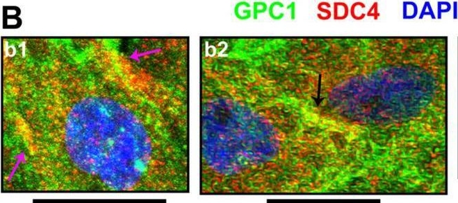 Fig.5.B showing Immunocytochemistry-immunofluorescence from the publication: Glypican-1 in human glioblastoma: implications in tumorigenesis and chemotherapy.
