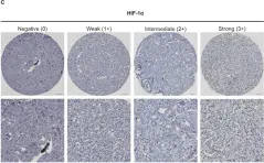 Fig.1.C showing Immunohistochemistry in a Homo sapiens (Human) sample from the publication: Cytoplasmic HIF-2α as tissue biomarker to identify metastatic sympathetic paraganglioma.