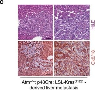 Loss of ATM accelerates pancreatic cancer formation and epithelial-mesenchymal transition.