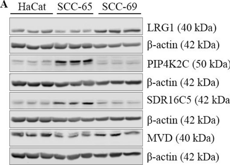 Fig.2.A showing Western Blotting in a Homo sapiens (Human) sample from the publication: LRG1 and SDR16C5 protein expressions differ according to HPV status in oropharyngeal squamous cell carcinoma.