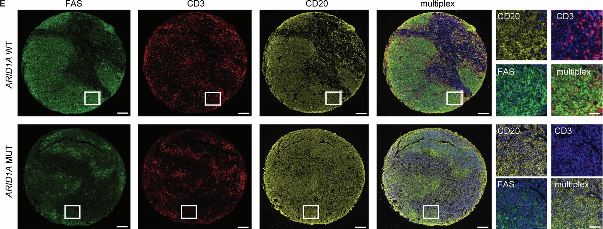 Fig.1.E showing Immunohistochemistry-immunofluorescence in a Homo sapiens (Human) sample from the publication: ARID1A mutations protect follicular lymphoma from FAS-dependent immune surveillance by reducing RUNX3/ETS1-driven FAS-expression.