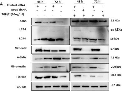 Fig.2.A showing Western Blotting from the publication: A Feedback Loop between TGF-β1 and ATG5 Mediated by miR-122-5p Regulates Fibrosis and EMT in Human Trabecular Meshwork Cells.
