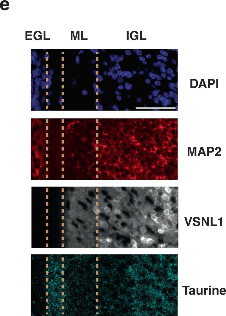 Fig.6.E showing Immunohistochemistry-immunofluorescence in a Homo sapiens (Human) sample from the publication: Developmental basis of SHH medulloblastoma heterogeneity.