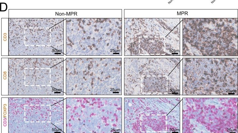 Fig.6.D showing Immunohistochemistry in a Homo sapiens (Human) sample from the publication: Characterization of the tumor microenvironment in locally advanced gastric cancer and identification of spatially predictive biomarkers associated with beneficial neoadjuvant immunochemotherapy.