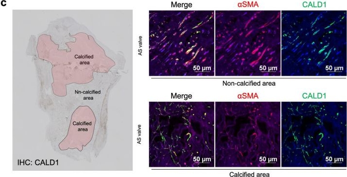Fig.1.C showing Immunohistochemistry-immunofluorescence in a Homo sapiens (Human) sample from the publication: Caldesmon-1-mediated actin dynamics is essential for osteogenic differentiation of aortic valve interstitial cells.