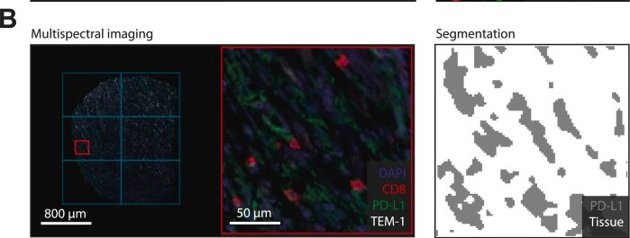 Fig.1.B showing Immunohistochemistry-immunofluorescence in a Homo sapiens (Human) sample from the publication: The effect of neoadjuvant radiotherapy on immune cell infiltrates in myxofibrosarcoma.