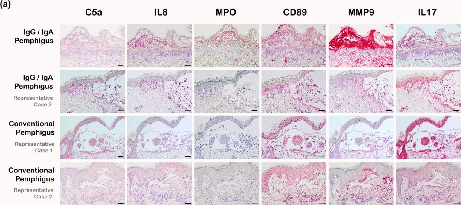 Fig.3.A showing Immunohistochemistry in a Homo sapiens (Human) sample from the publication: Clinical, Histopathologic, and Immunohistochemical Features of Patients with IgG/IgA Pemphigus.